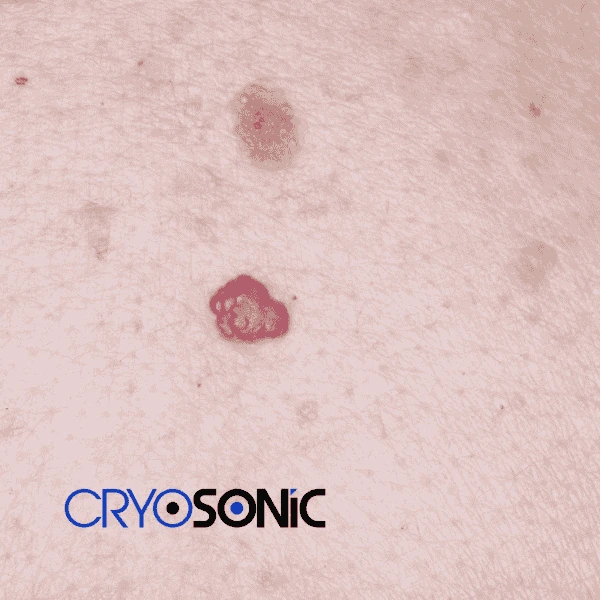 Looking for pain free cherry angioma removal treatment Chertsey? Call our team today! Chertsey