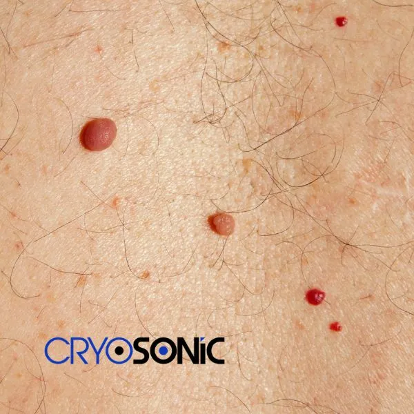 get cherry angioma removal treatment today! Chertsey