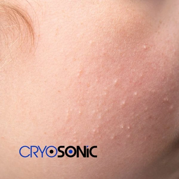 Are you looking for milia removal treatment? Contact our team today Chertsey