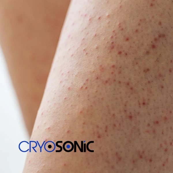 Looking for Seborrhoeic Keratosis removal Chertsey treatment? Call our consultants today in Chertsey