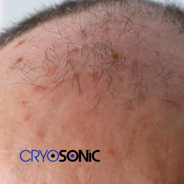 Access Seborrhoeic Keratosis removal from the comfort of your own home! Call us today in Chertsey