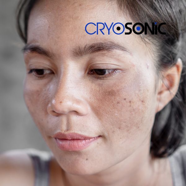 Ready to start age spots removal? Contact our team today in Chertsey