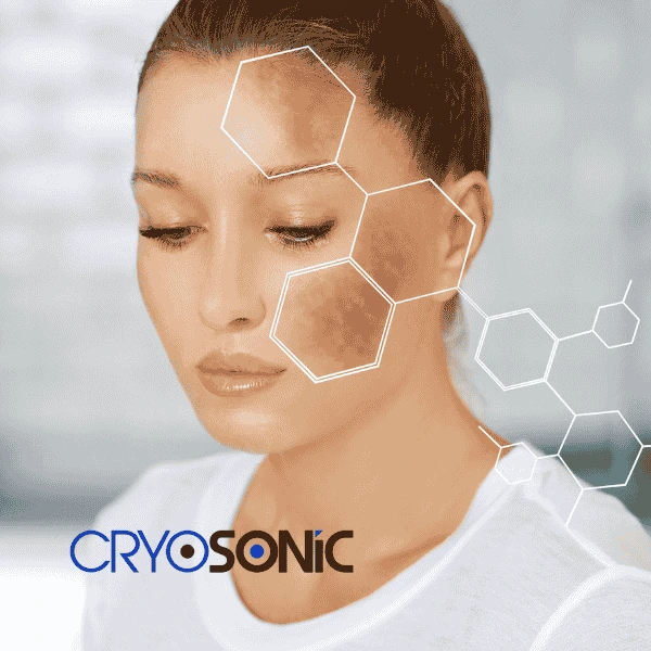 Are you looking for age spot removal treatment? Contact Cryosonic today in Chertsey