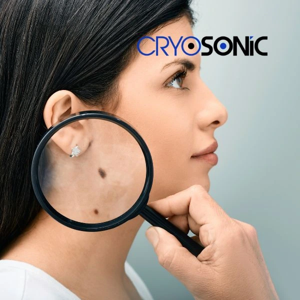 Do you want to learn more about benign moles removal treatment? Call our team today Chertsey