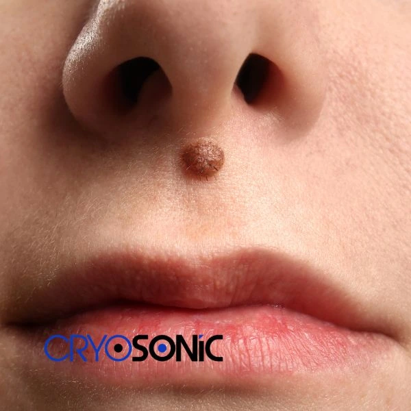 Start your benign moles removal treatment today Chertsey
