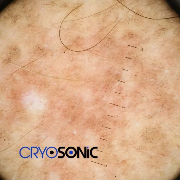 Speak to our team today about sun damaged skin treatment today in Chertsey
