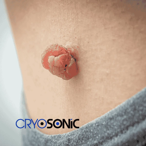 Book your skin tags removal Chertsey from comfort of your own home! Chertsey