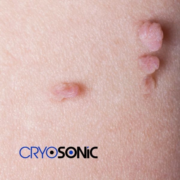 Are you looking for fast effect skin tag removal Chertsey? Book in NOW! Chertsey