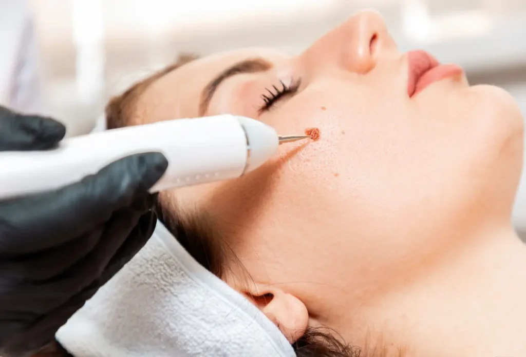 CryoPen Accuracy Chertsey being used to safely and precisely remove multiple skin lesions, illustrating answers to common patient FAQs Chertsey