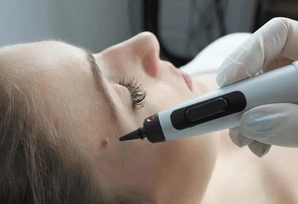 CryoPen accurately targeting skin lesions with millimetre-precision for safe and effective removal by Cryosonic Chertsey