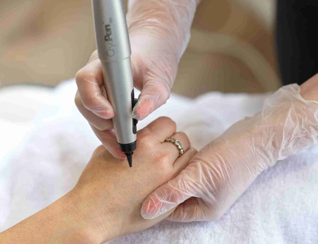 CryoPen Accuracy Chertsey in action, precisely targeting a skin lesion to ensure safe treatment and protect surrounding healthy skin Chertsey