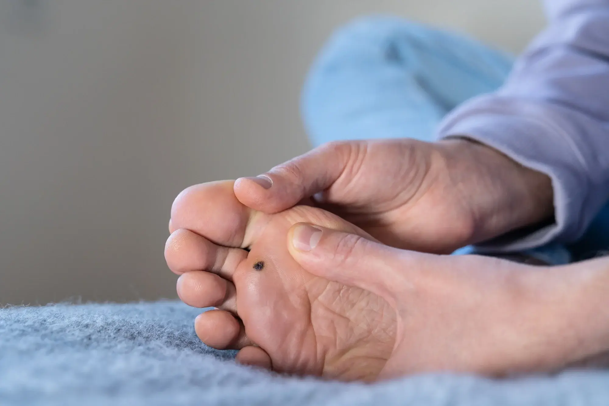 CryoPen treatment for multiple and stubborn Plantar Warts (Verrucae) Chertsey, showing safe, precise removal and patient-friendly procedure Chertsey
