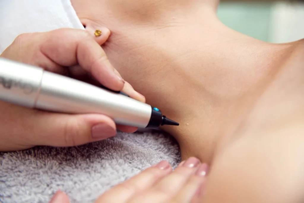 CryoPen precisely treating Molluscum Contagiosum lesions, showing safe and effective removal for faster healing by Cryosonic Chertsey