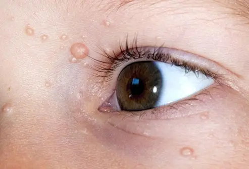 CryoPen treating persistent Molluscum Contagiosum Chertsey lesions Chertsey