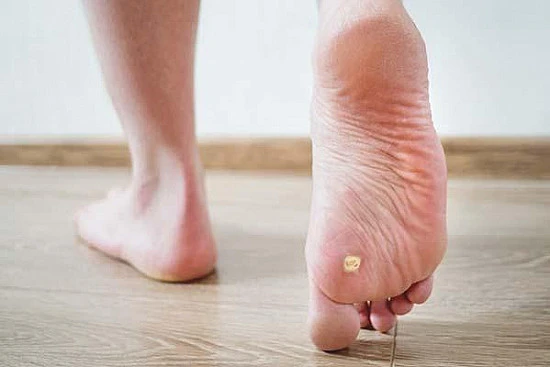 CryoPen treatment removing stubborn Plantar Warts (Verrucae) for precise, safe, and effective relief from resistant lesions Chertsey