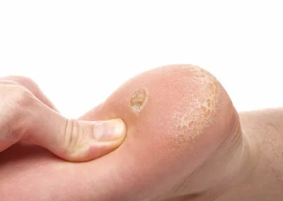 Painful Plantar Warts (Verrucae) Chertsey, highlighting how stubborn warts affect everyday activities and comfort Chertsey