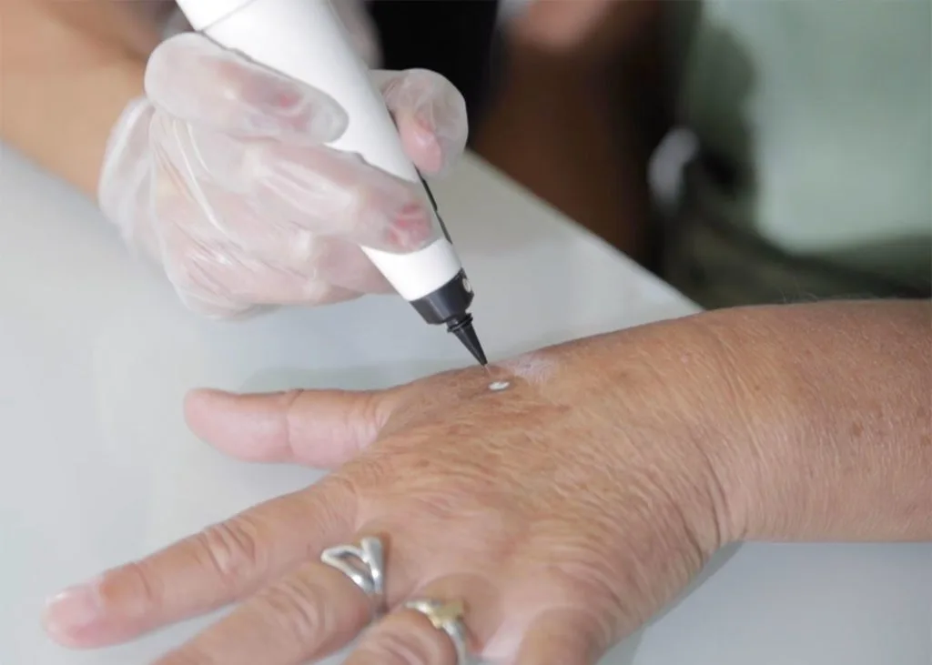 Close-up of CryoPen accuracy Chertsey targeting a skin lesion, showing why precision matters for safe and effective removal Chertsey