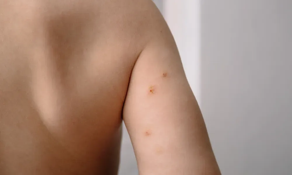 CryoPen treating Molluscum Contagiosum Chertsey professionally, highlighting safe and precise lesion removal for improved skin and confidence Chertsey
