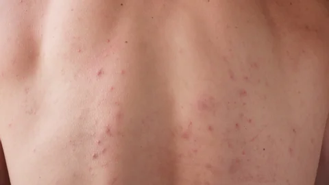 CryoPen treating Chertsey Molluscum Contagiosum lesions safely and precisely, illustrating answers to common patient FAQs Chertsey